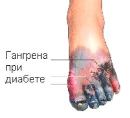 Гангрена пальца ноги при сахарном диабете лечение